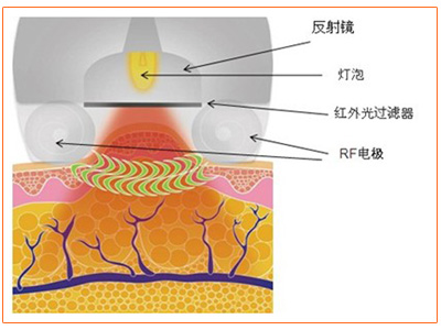 新一代緊致塑形系統——纖體減脂儀器SlimmingV+